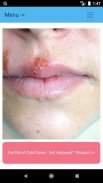 Cold Sore Cure Free App with Natural Remedies screenshot 5