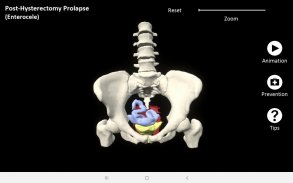 myProlapse: Anatomy of Post-Hysterectomy Prolapse screenshot 4