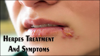 Herpes Treatment And Symptoms screenshot 2