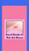 Natural Remedies For Boils And Abscesses screenshot 1