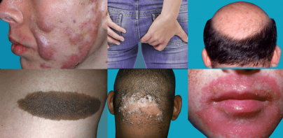 Skin diseases and treatment