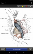 Zollinger's Atlas of Surgical Operations, 10/E screenshot 13