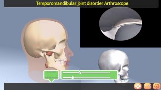 TMJ Arthroscope screenshot 2