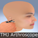 TMJ Arthroscope