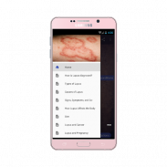 Lupus: Causes, Diagnosis, and Treatment screenshot 3