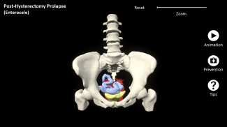 myProlapse: Anatomy of Post-Hysterectomy Prolapse screenshot 13