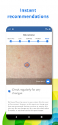 SkinVision - Detect Skin Cancer screenshot 1