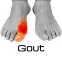 Gout Disease