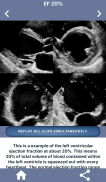 HEART EJECTION FRACTION screenshot 2