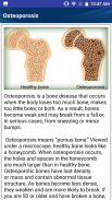 Osteoporosis Weak Bones Diet screenshot 13