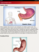 Peptic Ulcers Help & Diet Tips screenshot 1