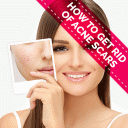 How to Get Rid of Acne Scars