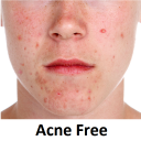 Acne skin care