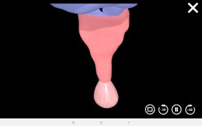 myProlapse: Anatomy of Post-Hysterectomy Prolapse screenshot 0