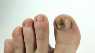 toenail fungus treatment screenshot 1