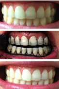 teeth whitening naturally tips screenshot 0