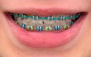 Dental Braces screenshot 1