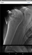 AO/OTA Fracture Classification screenshot 14