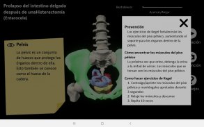 myProlapse: Anatomy of Post-Hysterectomy Prolapse screenshot 11