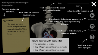 myProlapse: Anatomy of Post-Hysterectomy Prolapse screenshot 2