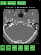 CT Cervical Spine screenshot 4