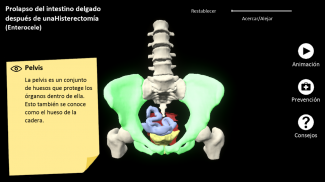 myProlapse: Anatomy of Post-Hysterectomy Prolapse screenshot 7