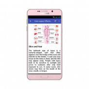 Lupus: Causes, Diagnosis, and Treatment screenshot 2