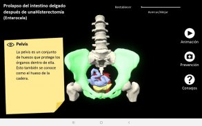 myProlapse: Anatomy of Post-Hysterectomy Prolapse screenshot 10