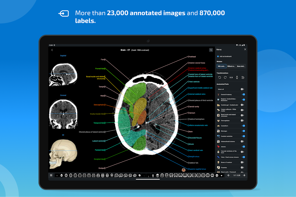 Bones of cranium - e-Anatomy - IMAIOS