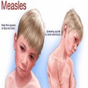 Measles Disease & Treatment Icon