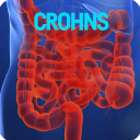 Crohns Disease