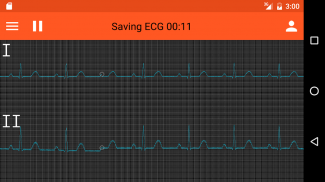 Spaulding ECG screenshot 2