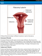 Uterine Fibroid Treatment Help screenshot 0