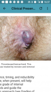 Hemorrhoid & Treatment screenshot 3