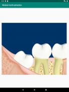 Dental diagnosis & patient education aid - Dentalk screenshot 8