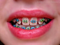 Dental Braces screenshot 4