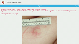 Pressure Ulcer screenshot 17