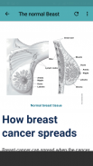 Breast Cancer screenshot 1