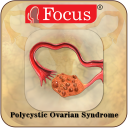 Polycystic Ovarian Syndrome Icon