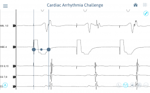 Cardiac Arrhythmia Challenge screenshot 5