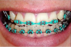 Dental Braces screenshot 0