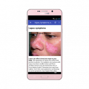 Lupus: Causes, Diagnosis, and Treatment screenshot 4