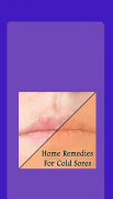 Home Remedies For Cold Sores screenshot 6