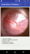 Small Atlas of Otoscopy screenshot 2