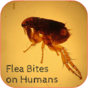 Signs of Flea Bites.