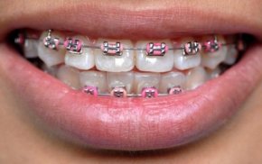 Dental Braces screenshot 3