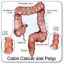 Colon Cancer