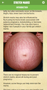 Get rid of STRETCH MARKS - Home Remedies screenshot 0