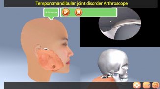 TMJ Arthroscope screenshot 1