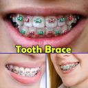 Tooth Brace Ideas